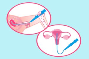 Histeroscopia para identificar pólipos uterinos